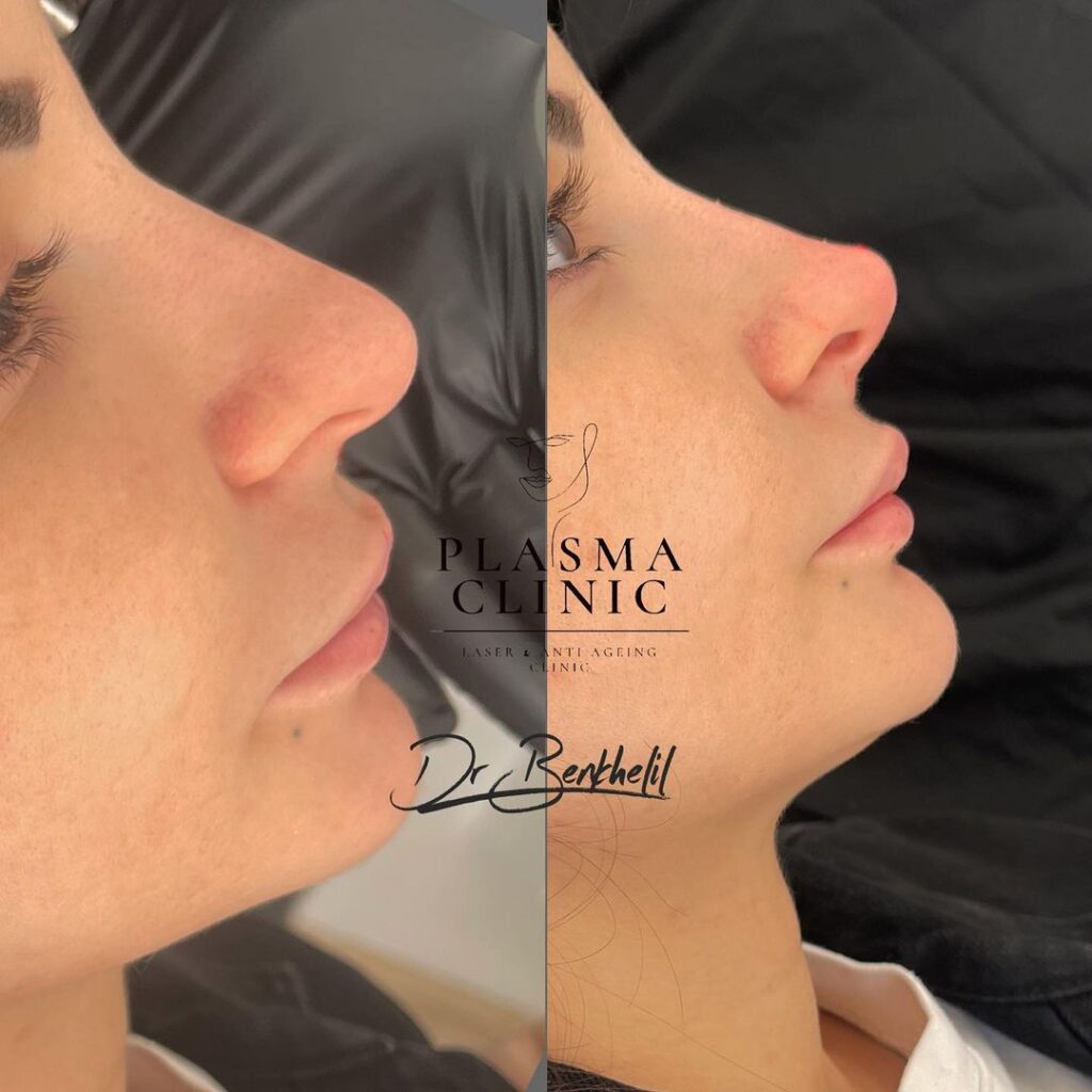 Avant / Après Rhinoplastie médicale avec injection d'acide hyaluronique à Alger en Algérie