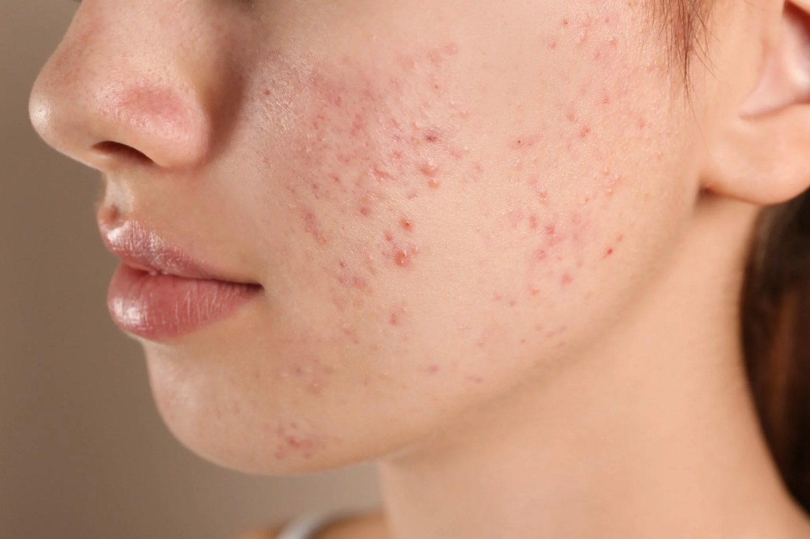 Cicatrices d'acné : inflammatoire / hyper pigmenté / hypo Pigmenté ...